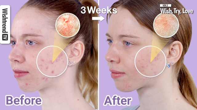 How to REALLY Treat Acne: 6 Major Tips to Keep Acne Under Control!ㅣWish, Try, Love